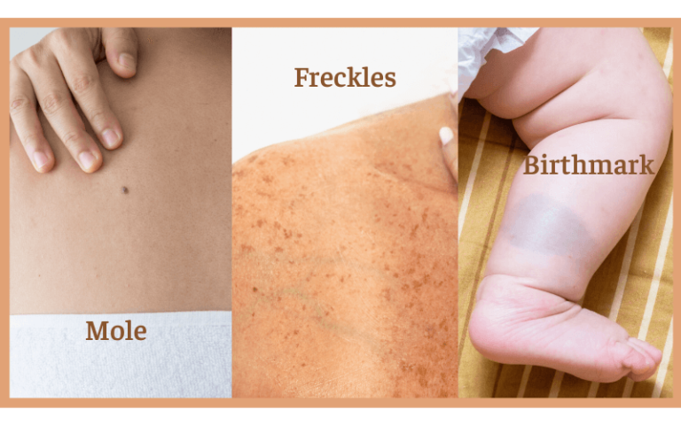 Can You Get A Tattoo Over Moles, Freckles, and Birthmarks? - Tattoo Moisturiser